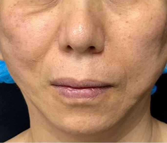 Case 01 After 術直後