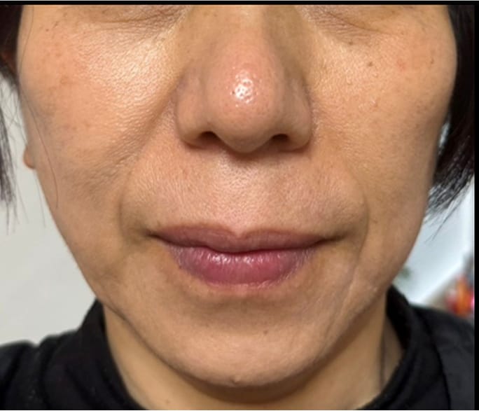 Case 01 After 1ヶ月半後