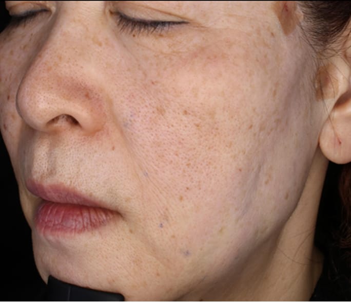 Case 02 After 術直後