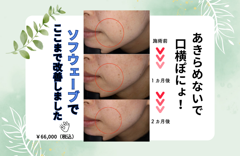 口横ぽにょソフウェーブ症例