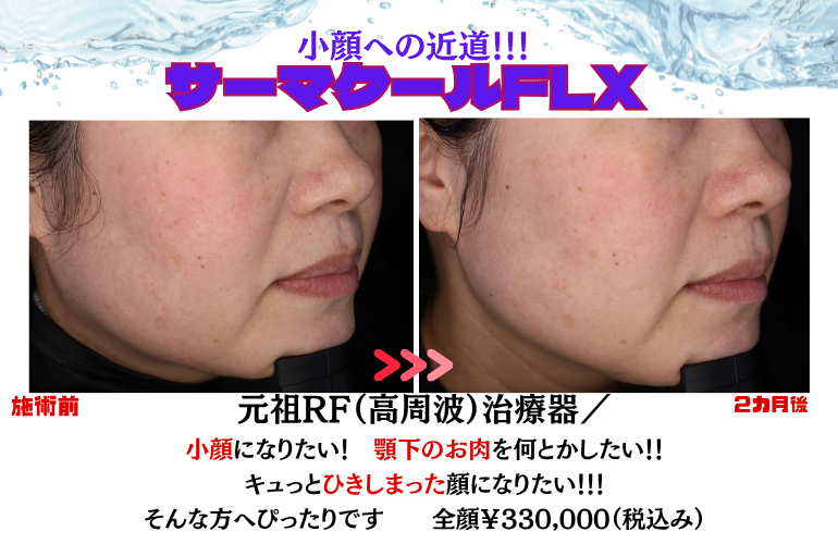 頬、二十顎をひきしめて小顔へ