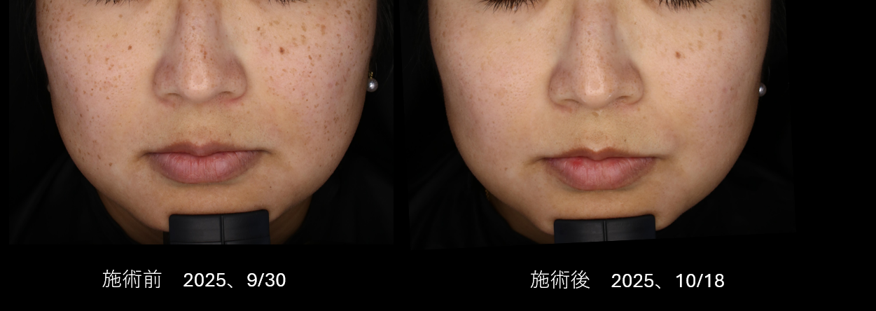 ソバカスくすみ一掃！！光治療